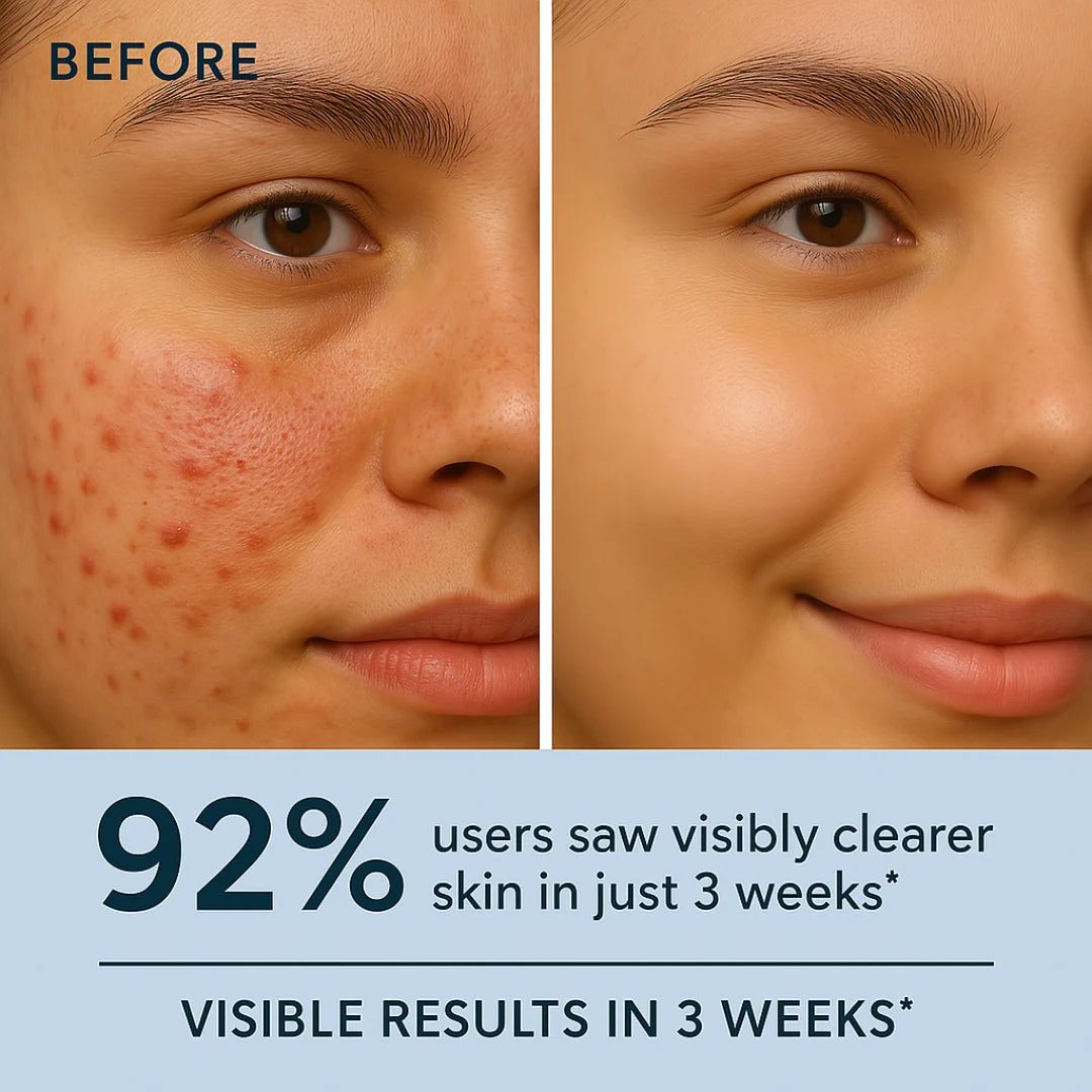 Salicylic Acid With Zinc Face Cleanser for Oily, Acne Prone Skin | Deeply Cleanse Pores | Oil-Control Formula -(100ml)